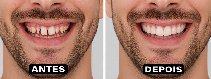Antes e Depois Facetas de Porcelana - DentVidaMed - Curitiba